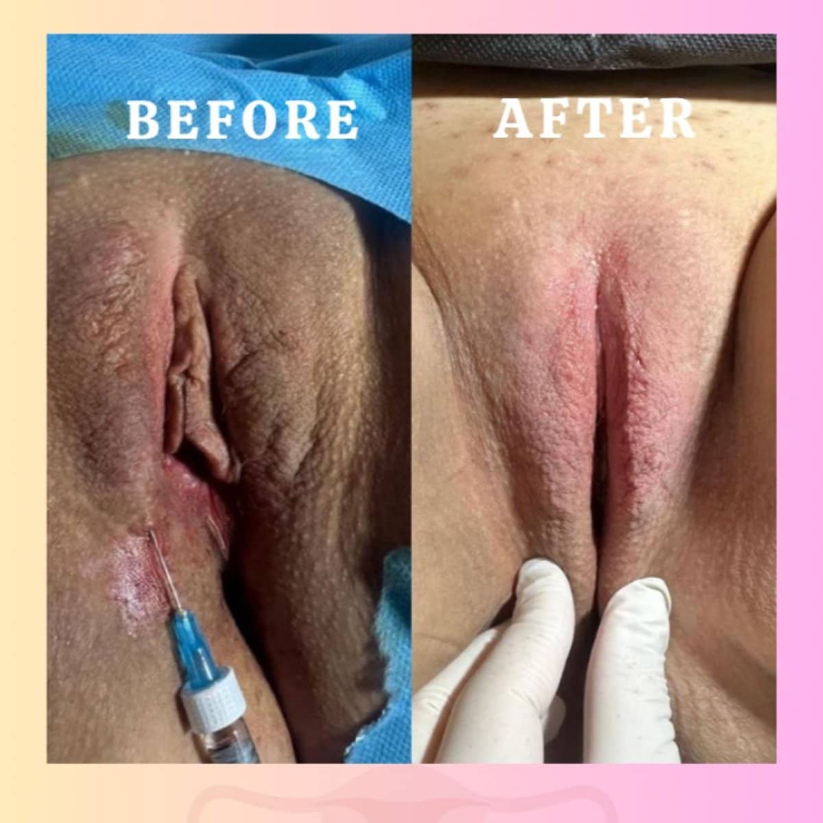 Case 16977 - labiaplasty