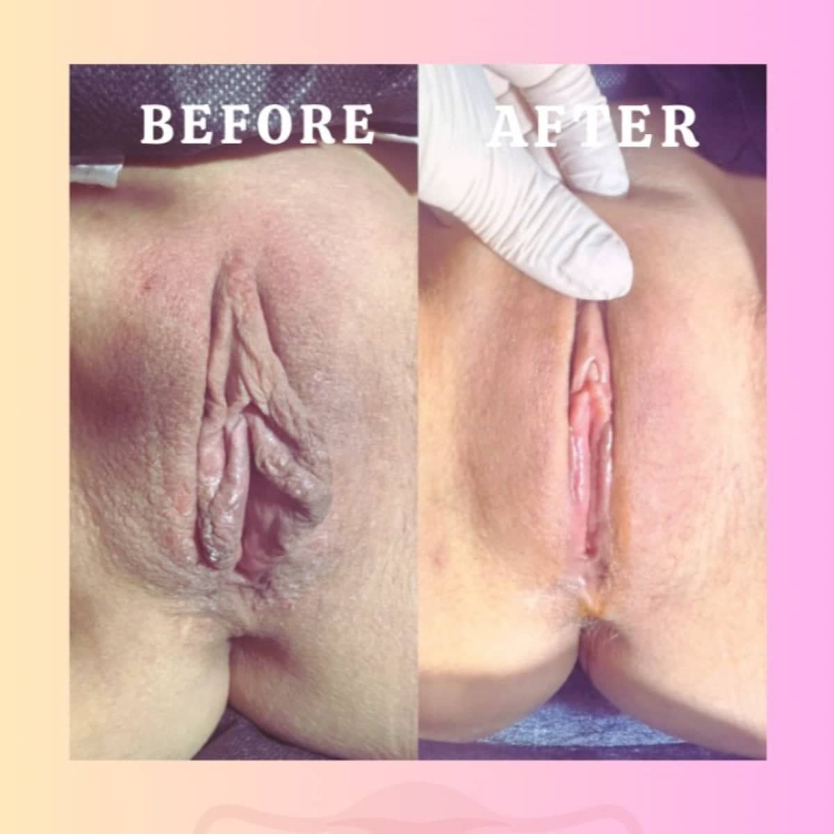 Case 16979 - clitoroplasty