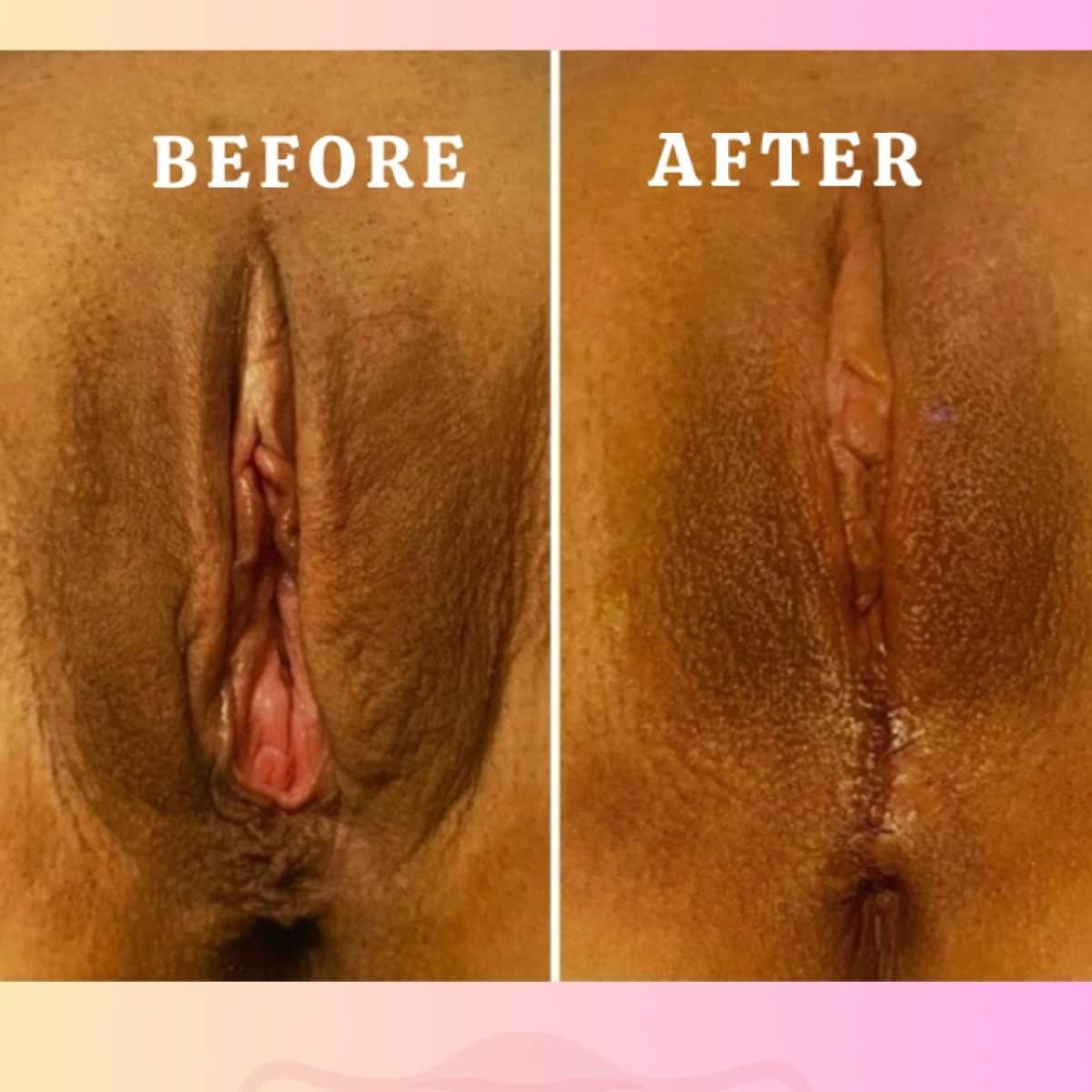 Case 16984 - vaginal tightening