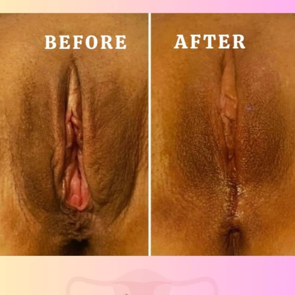 Case 16985 - laser vaginal rejuvenation