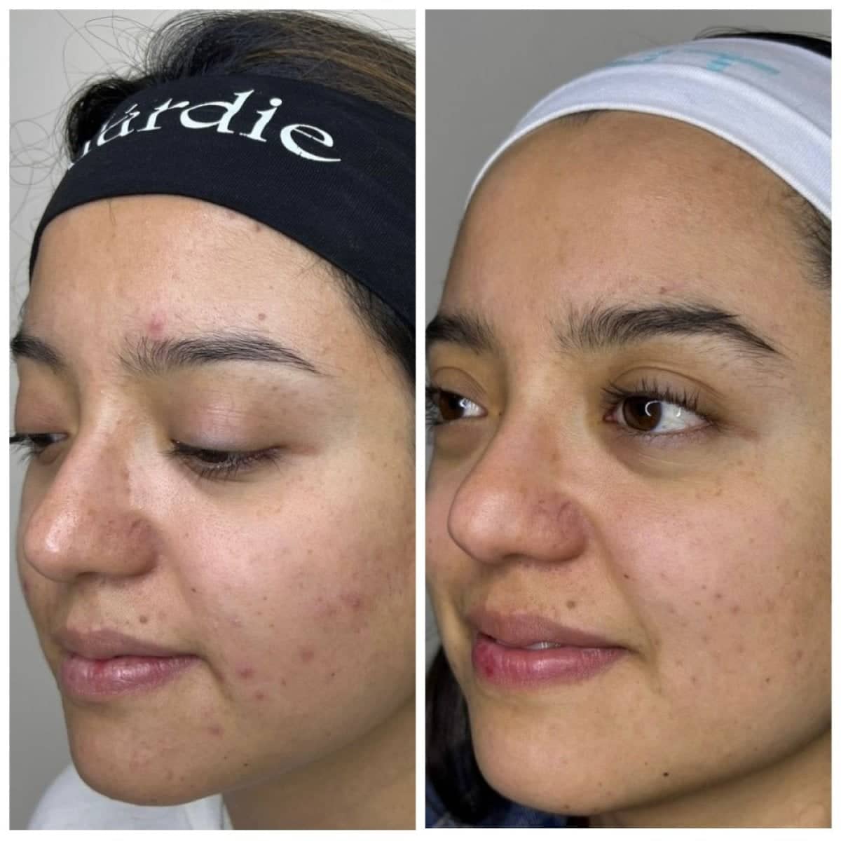 Case 17000 - chemical peel