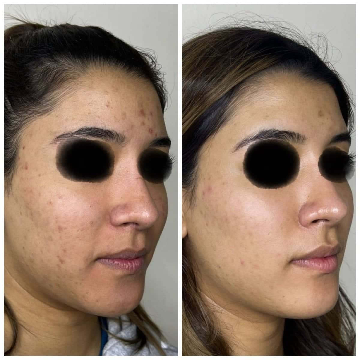 Case 17003 - chemical peel