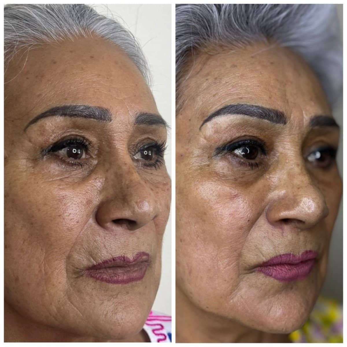 Case 17025 - chemical peel