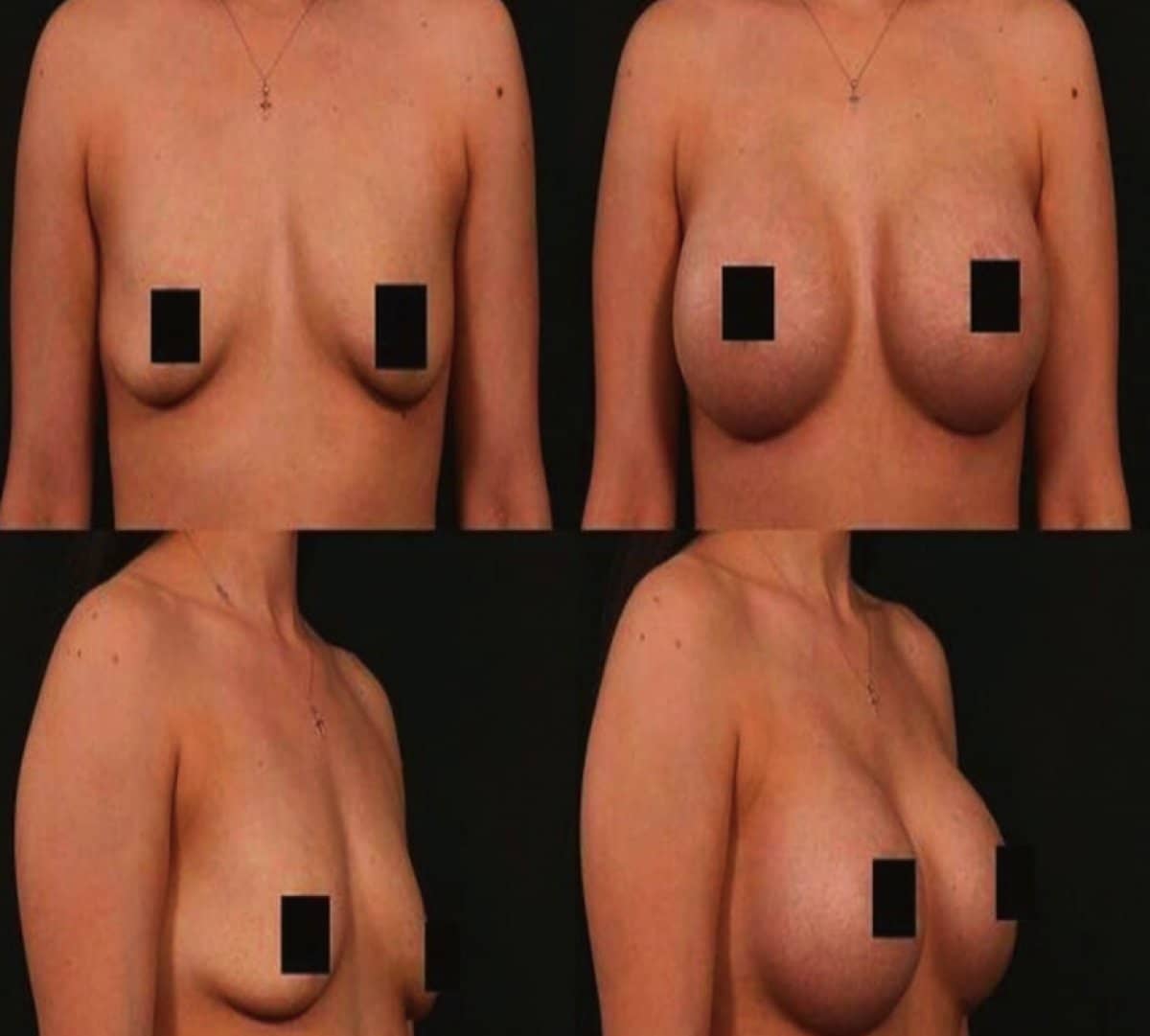 Case 17037 - breast augmentation