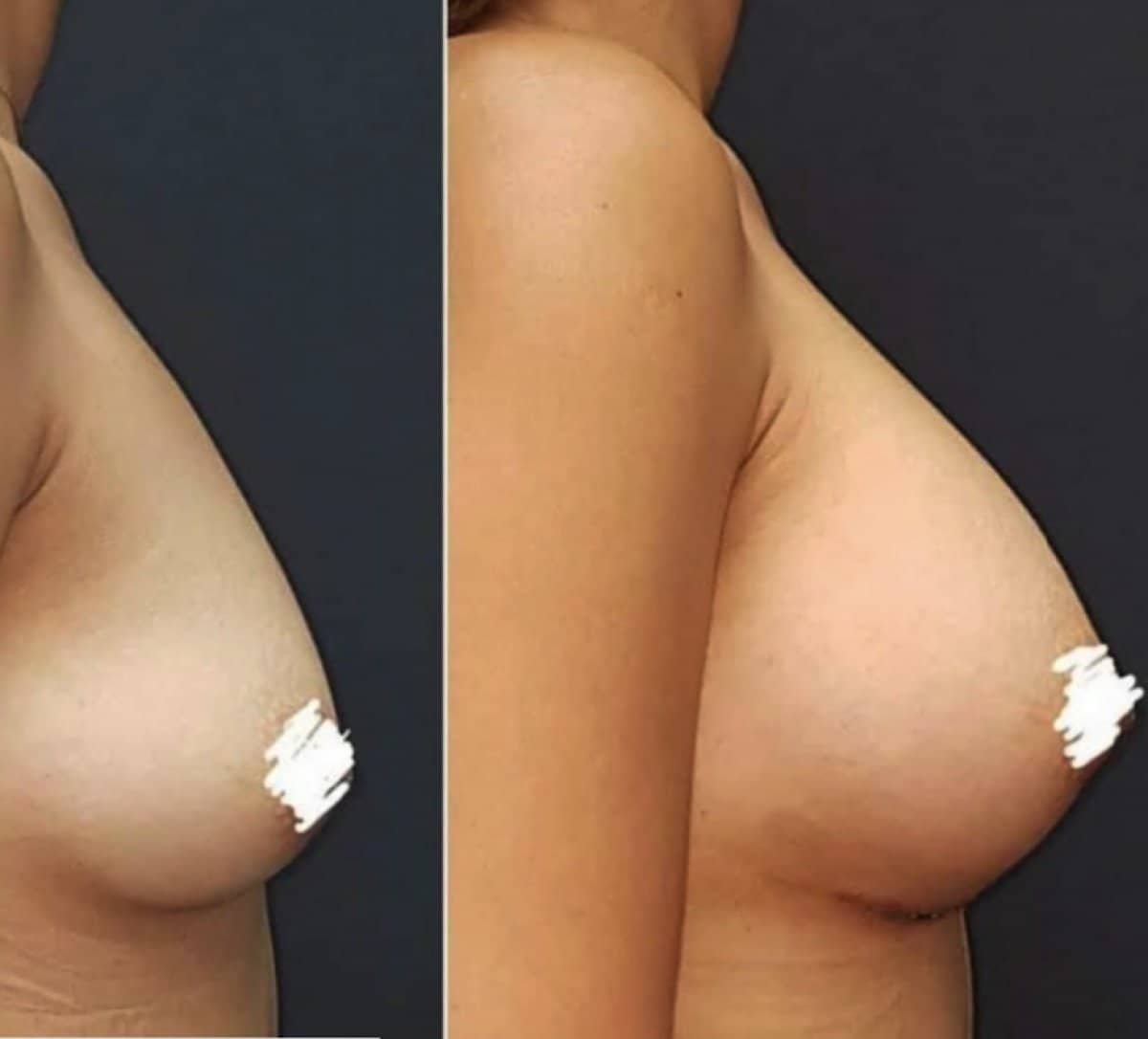 Case 17038 - breast implants with lift