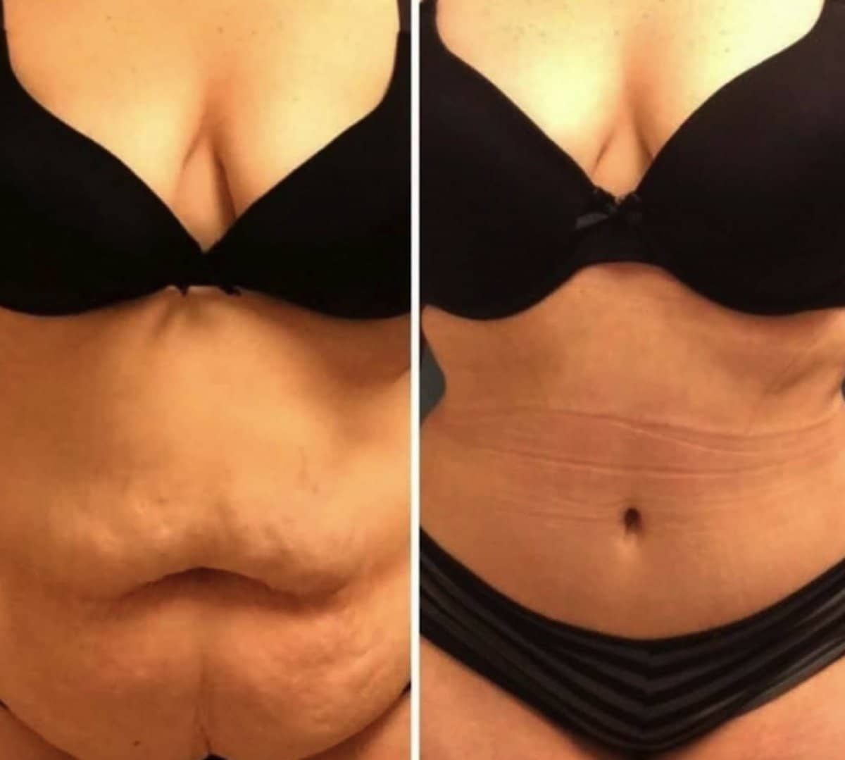 Case 17039 - liposuction