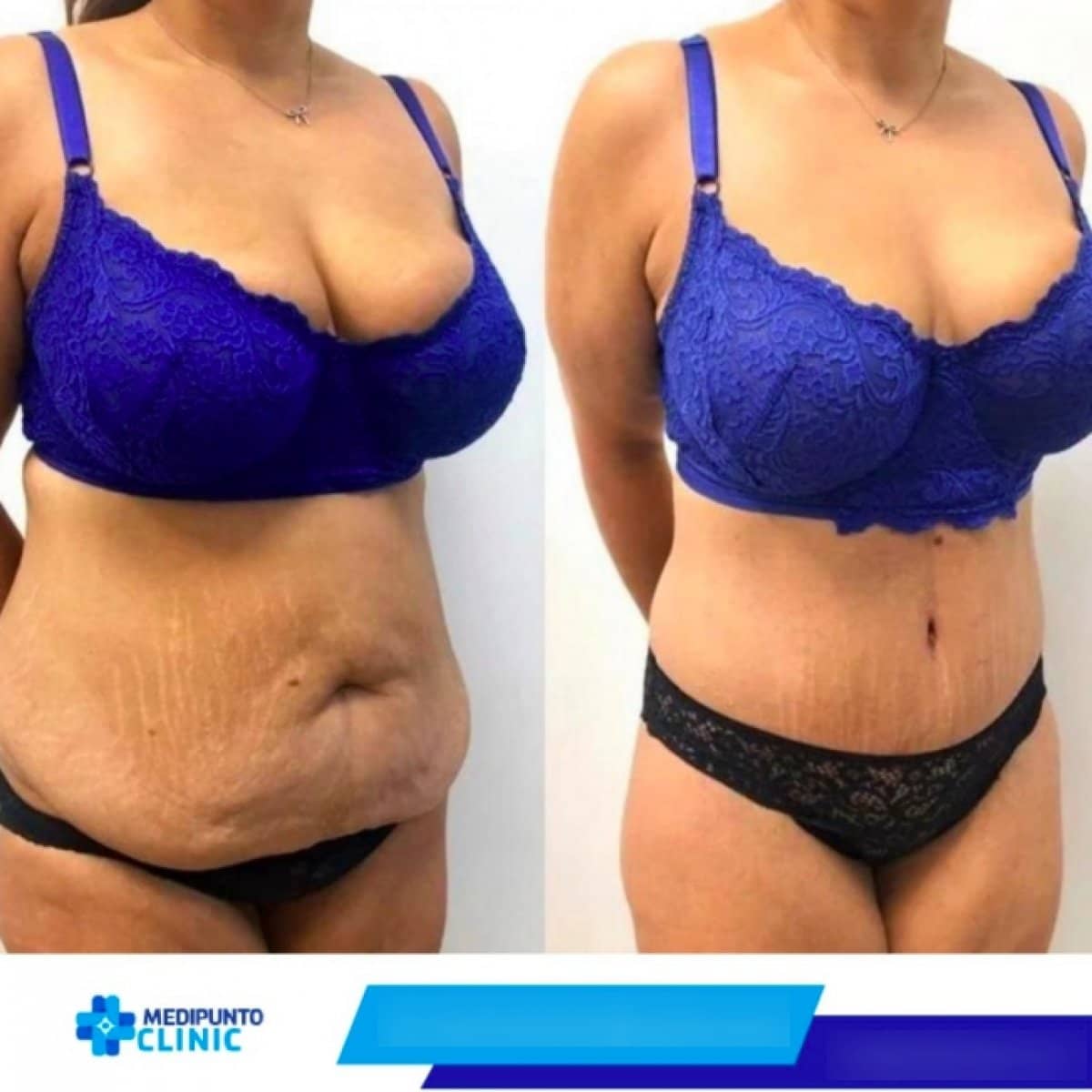 Case 17040 - tummy tuck