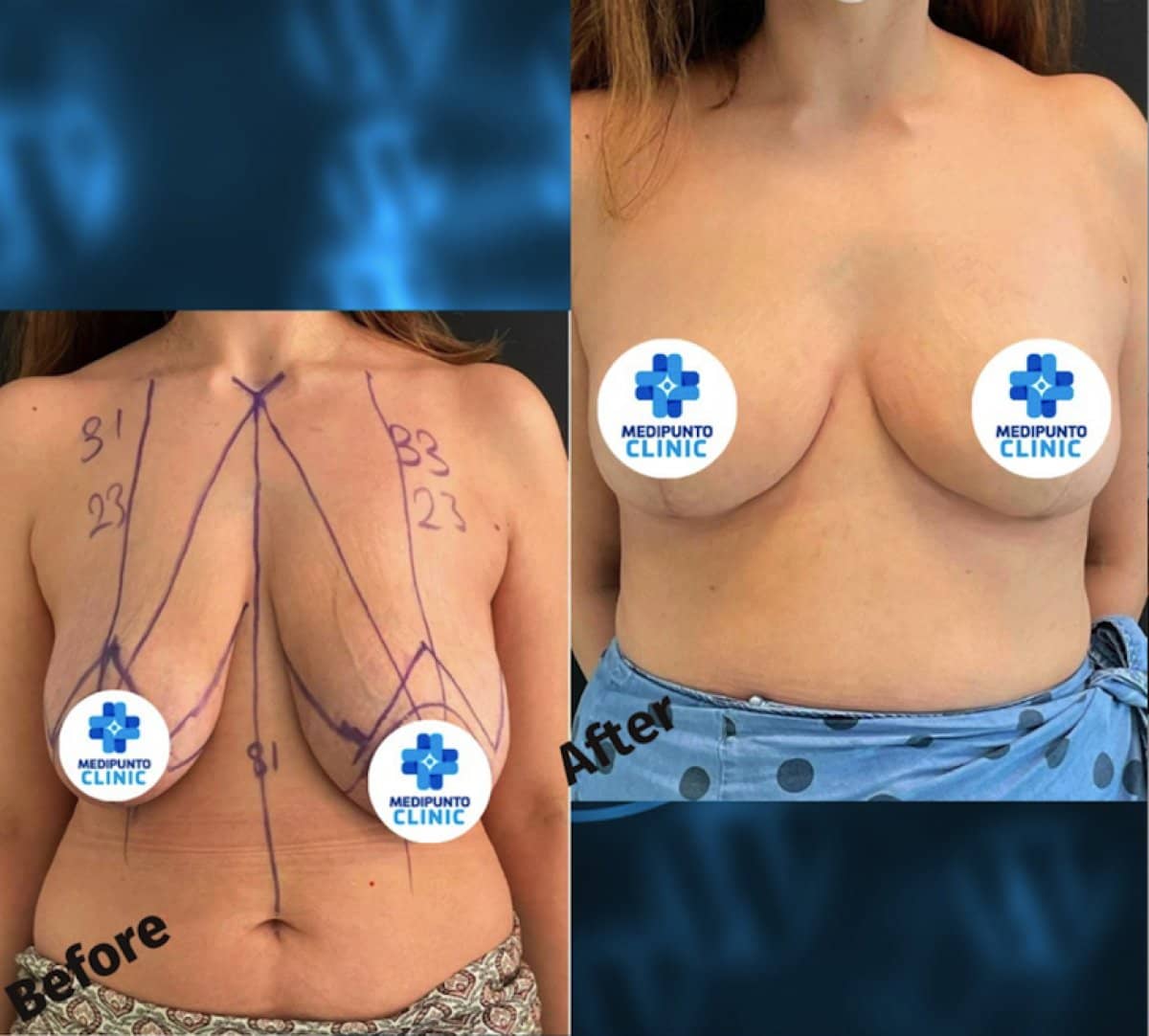 Case 17042 - breast reconstruction surgery
