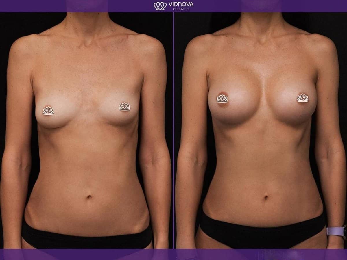 Case 17063 - breast augmentation