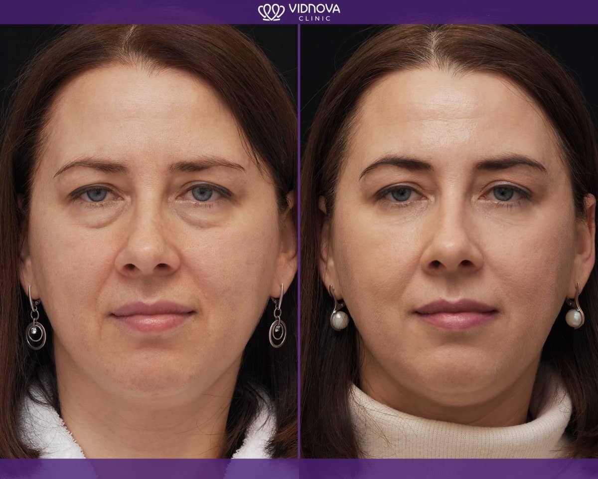 Case 17064 - lower eyelid blepharoplasty
