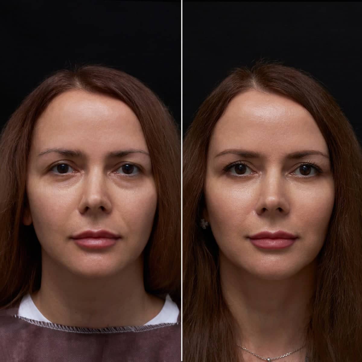 Case 17068 - blepharoplasty