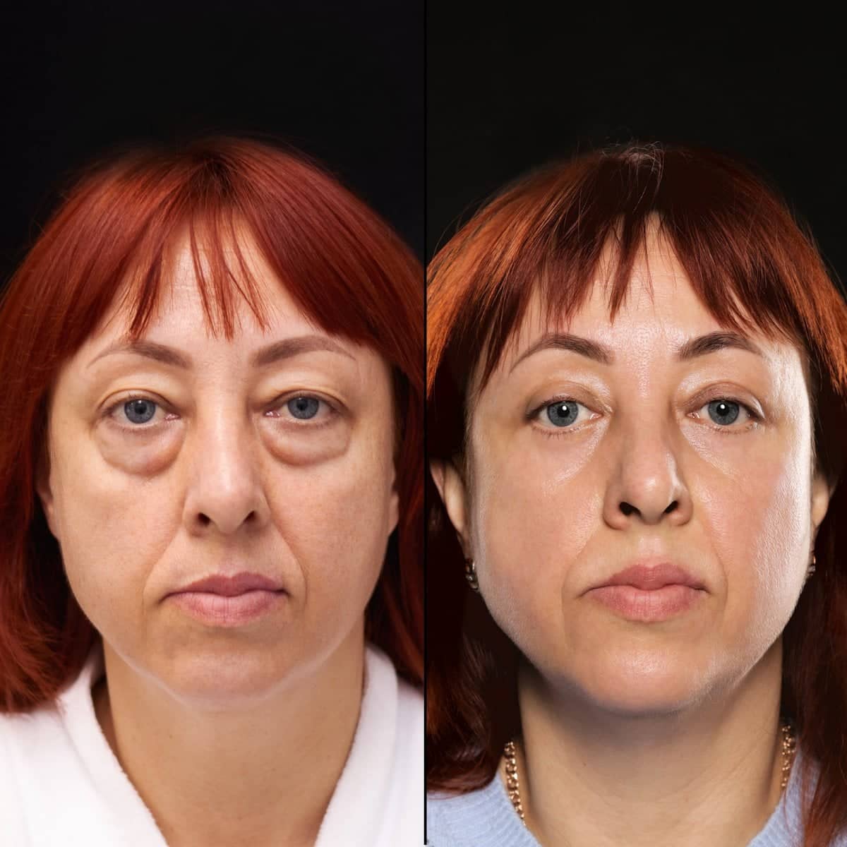 Case 17070 - blepharoplasty