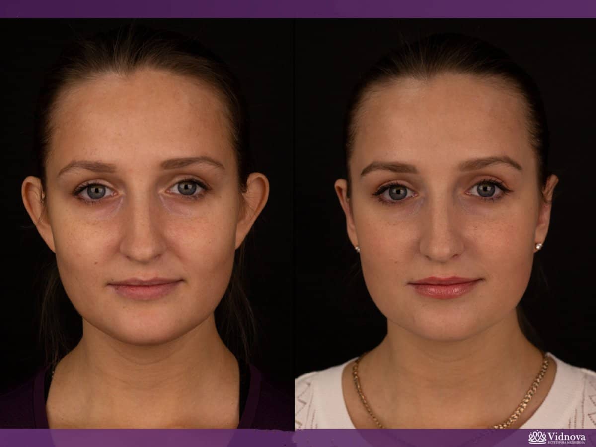 Case 17071 - otoplasty