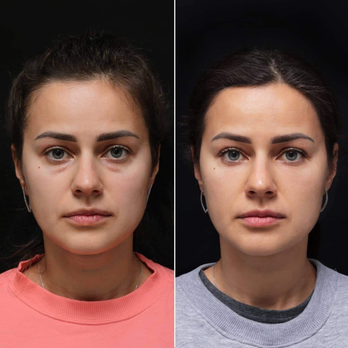 Case 17073 - blepharoplasty
