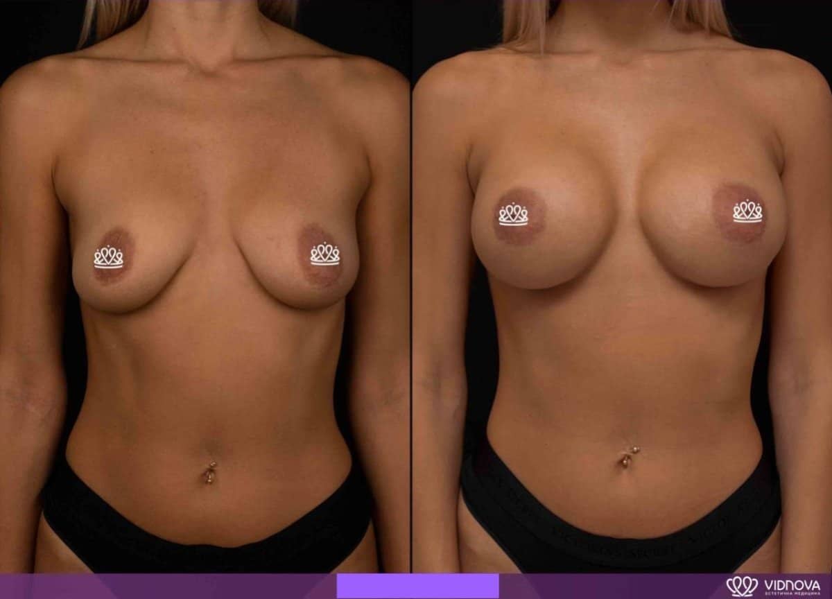 Case 17074 - breast augmentation