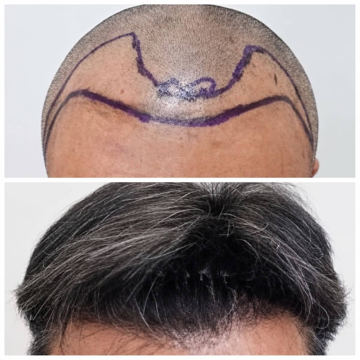 Case 17164 - hair transplant