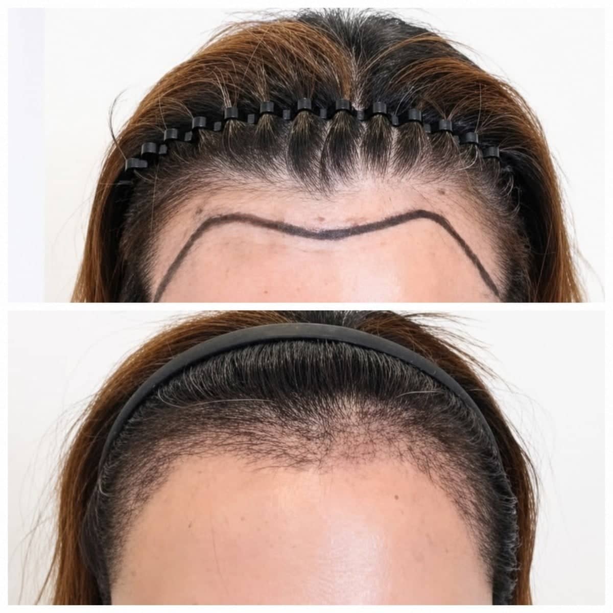 Case 17166 - hair transplant