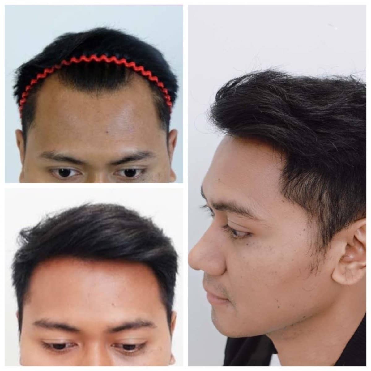 Case 17169 - hair transplant