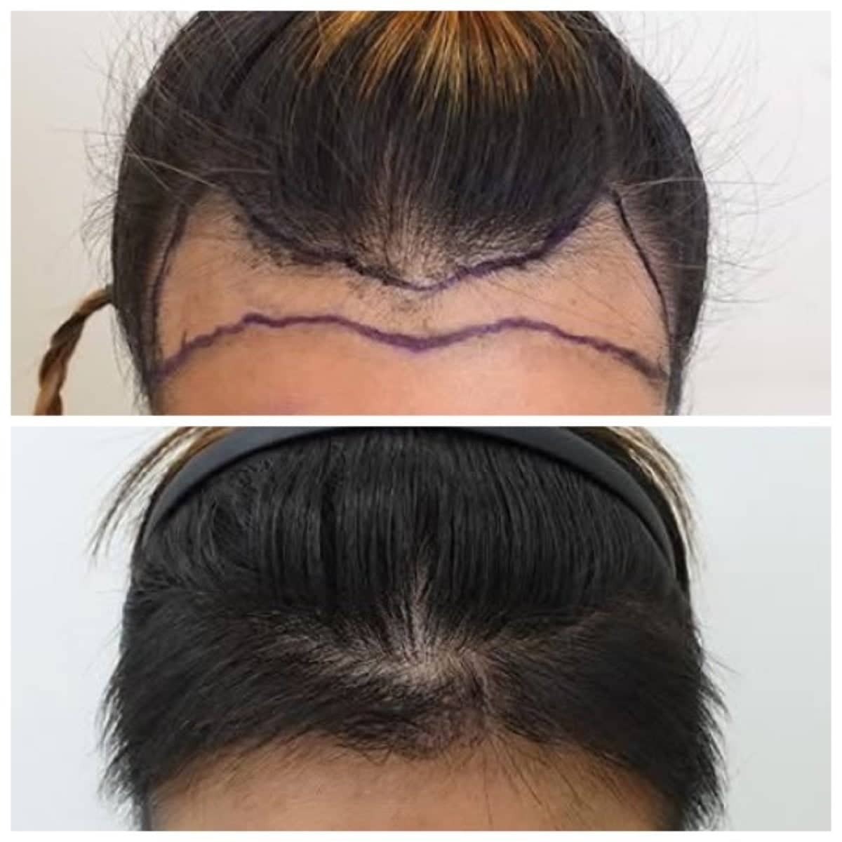 Case 17170 - hair transplant
