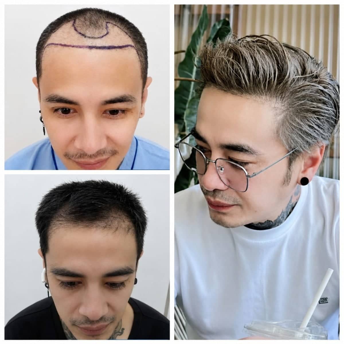 Case 17171 - hair transplant