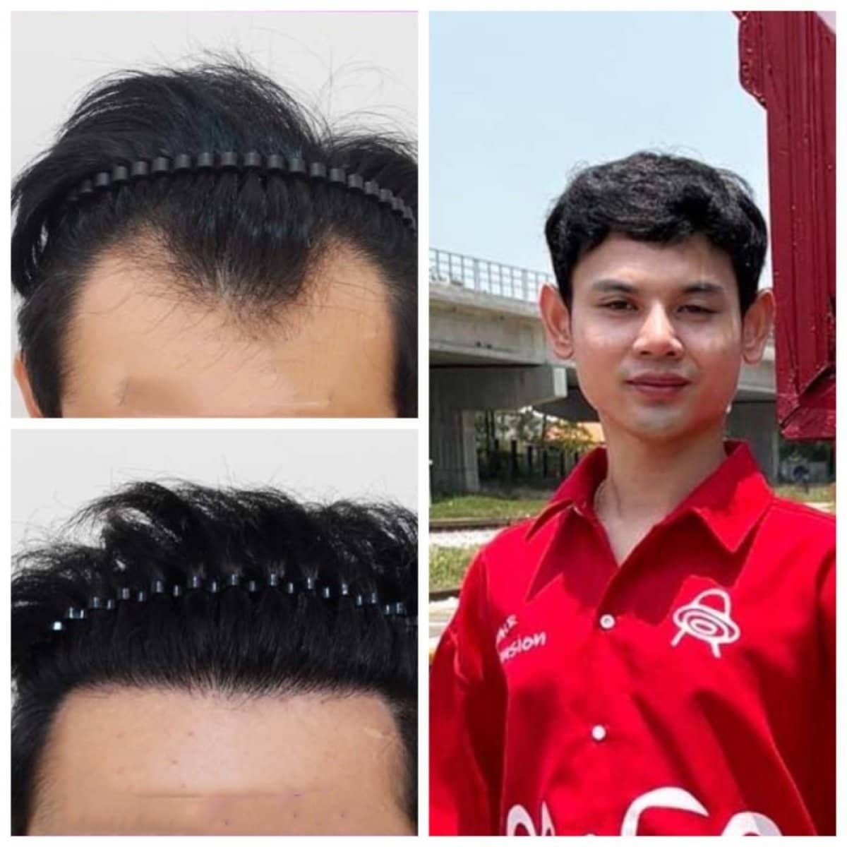 Case 17174 - hair transplant