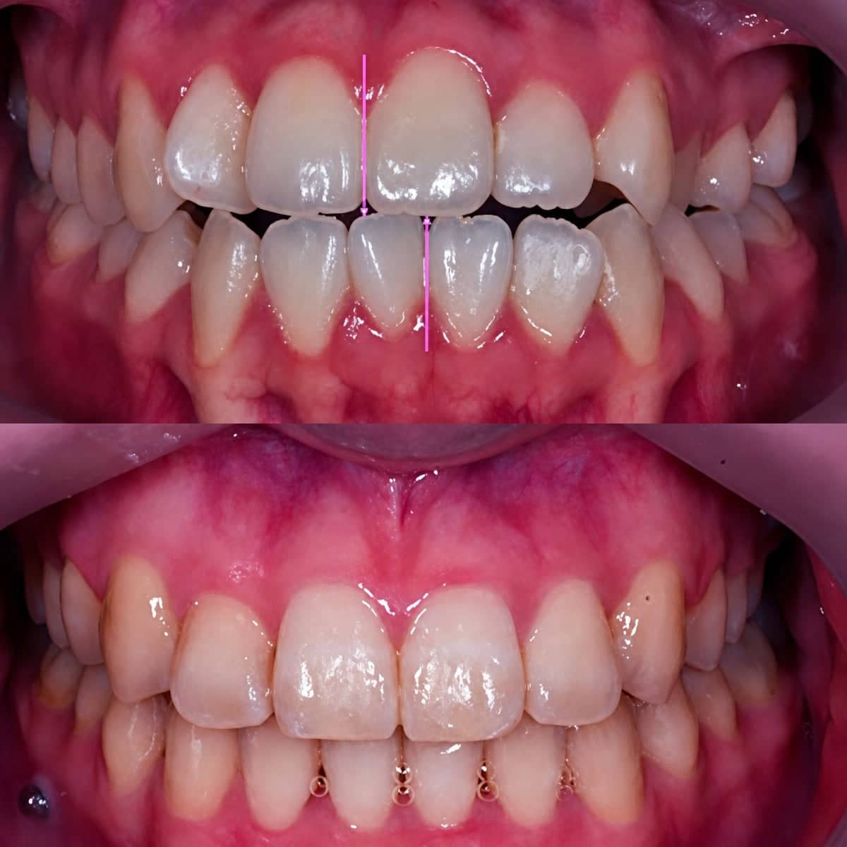 Case 17223 - braces