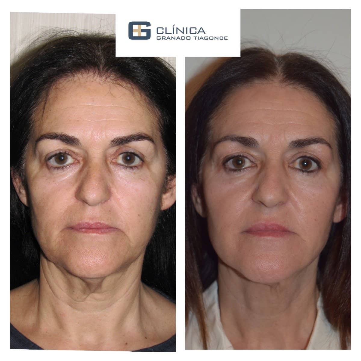 Case 17230 - fillers injection