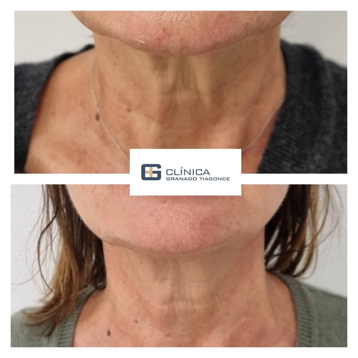 Case 17234 - fillers injection