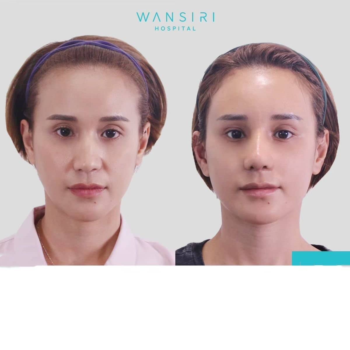 Case 17242 - brow lift