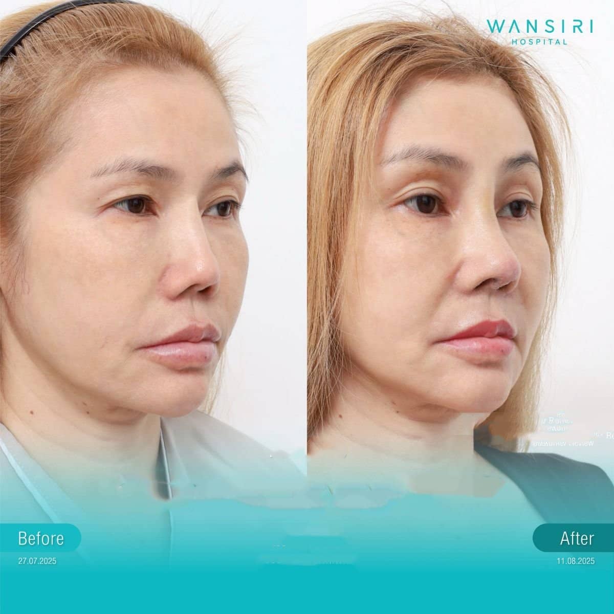 Case 17245 - endoscopic facelift