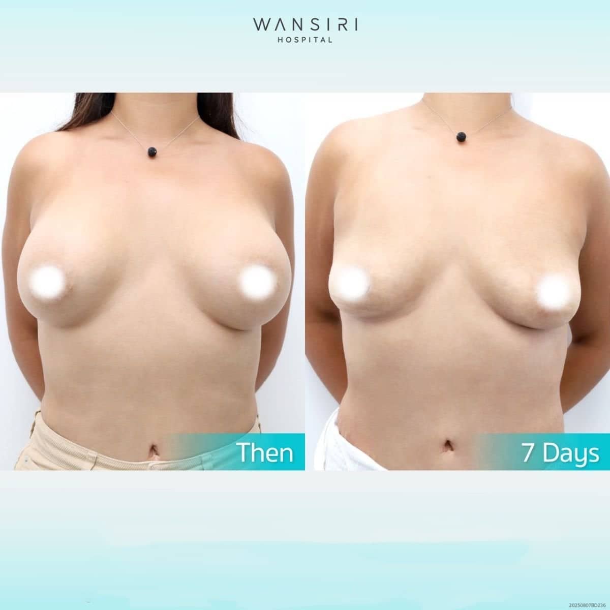 Case 17246 - breast implant removal