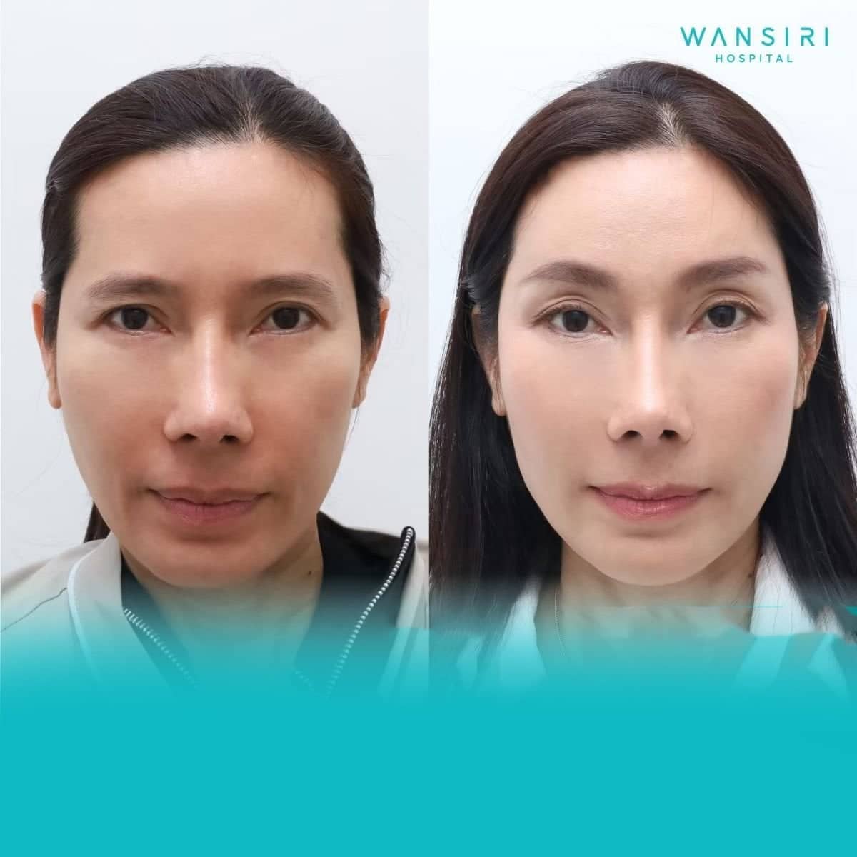 Case 17247 - Fox Eye Lift
