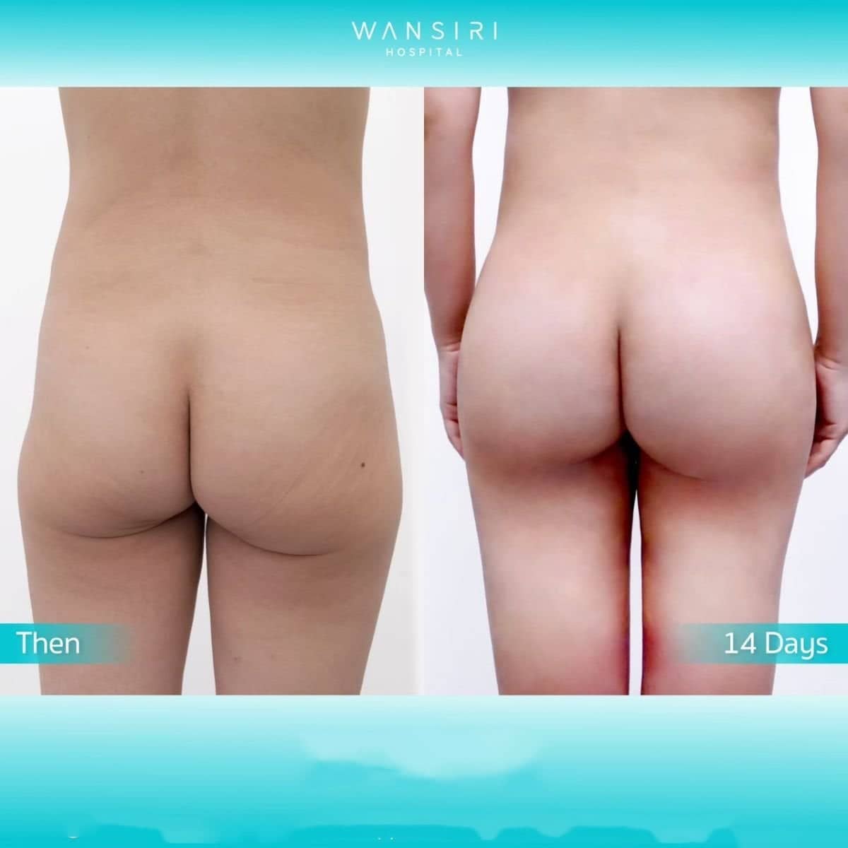 Case 17248 - butt implants