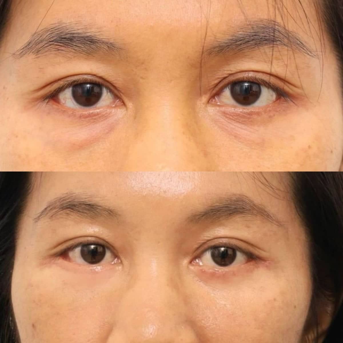 Case 17250 - lipofilling under eyes
