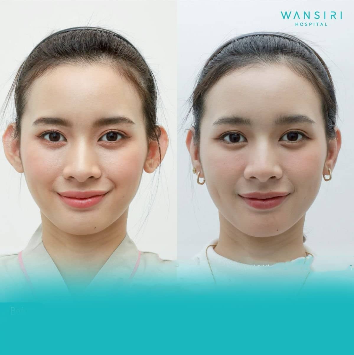 Case 17251 - otoplasty