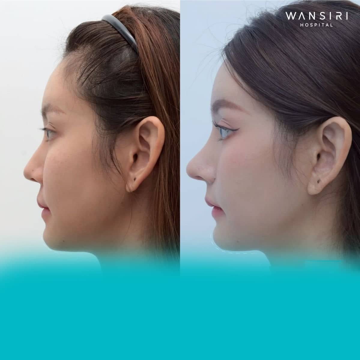 Case 17252 - rhinoplasty