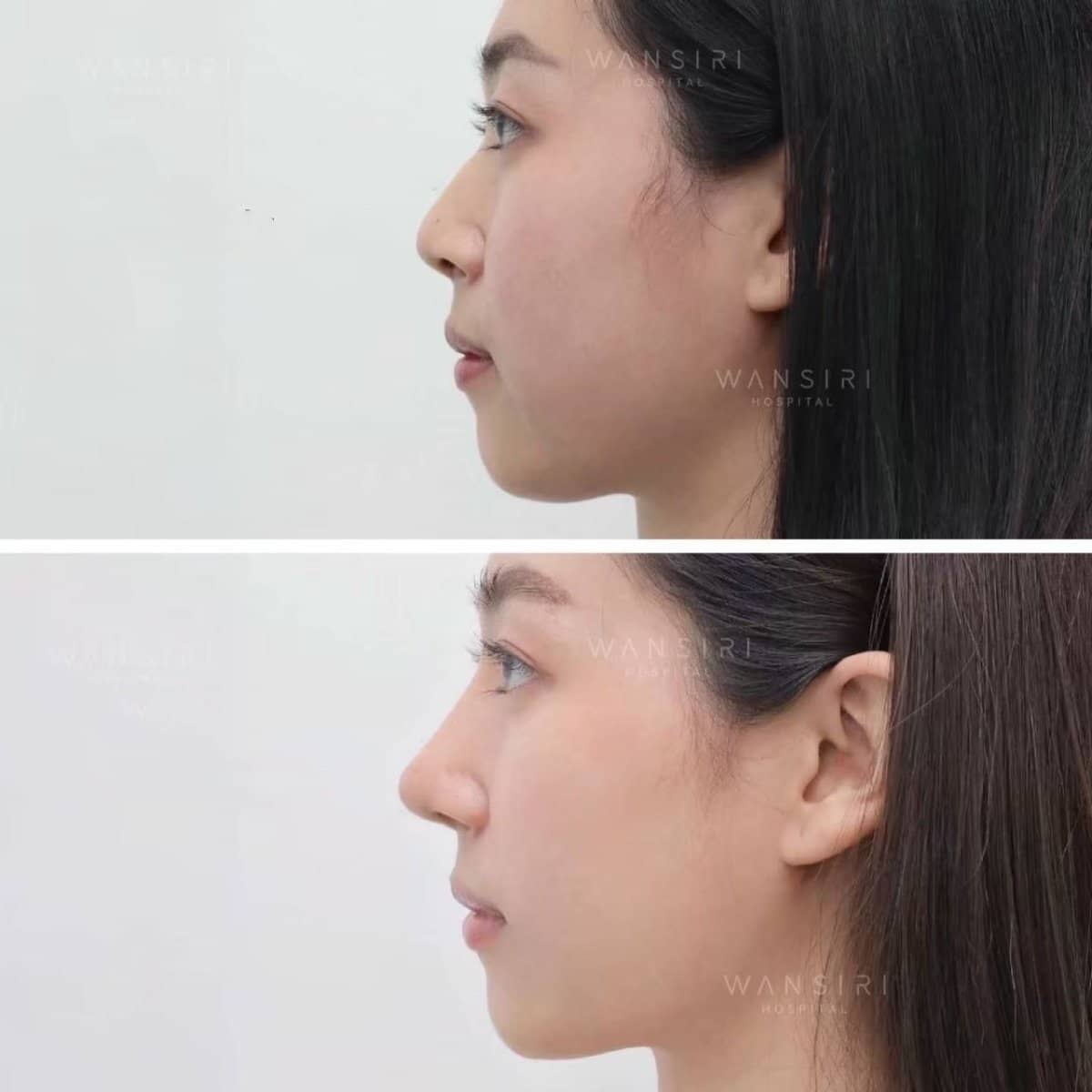 Case 17253 - rhinoplasty