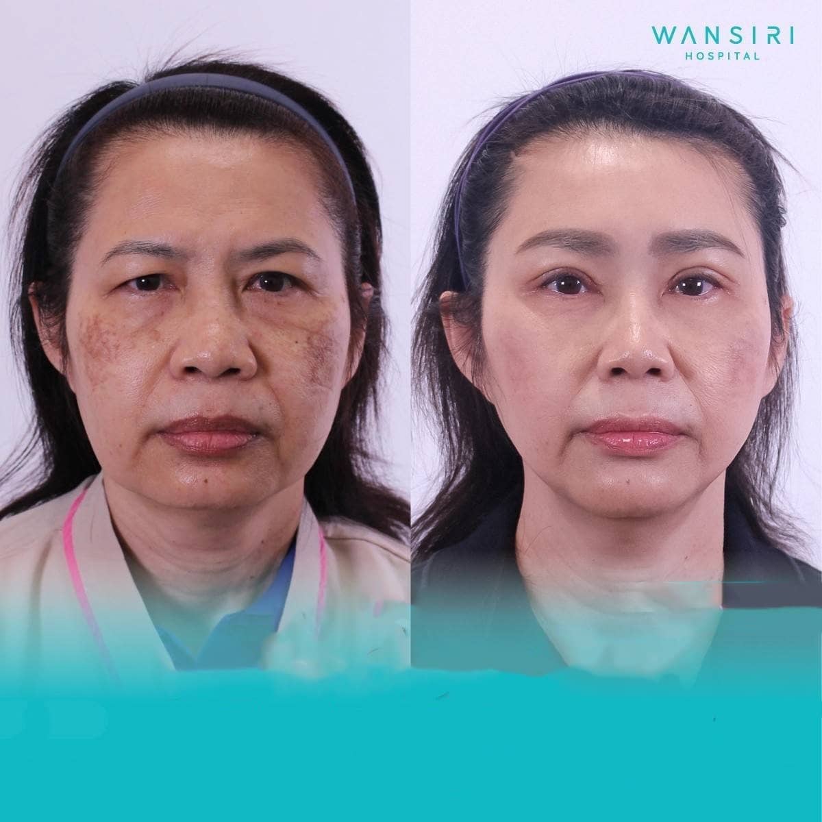 Case 17254 - brow lift