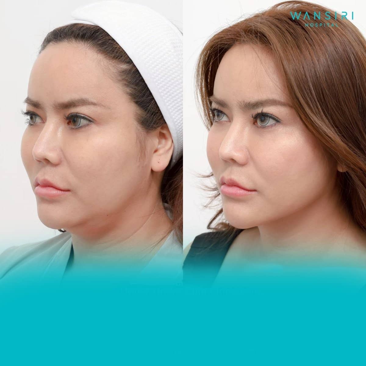 Case 17255 - liposuction