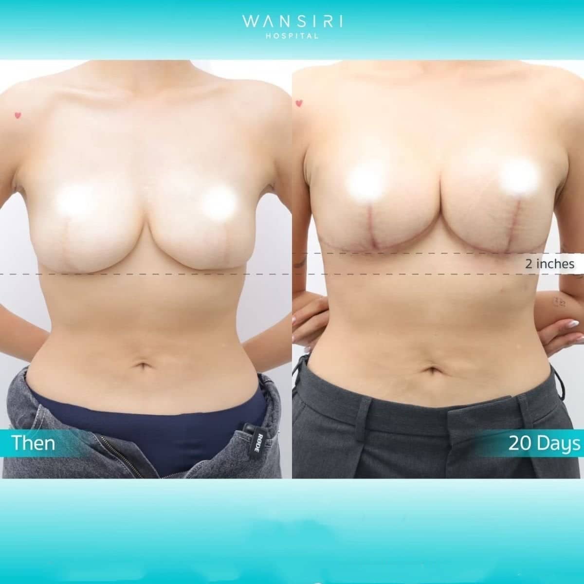 Case 17261 - breast lift