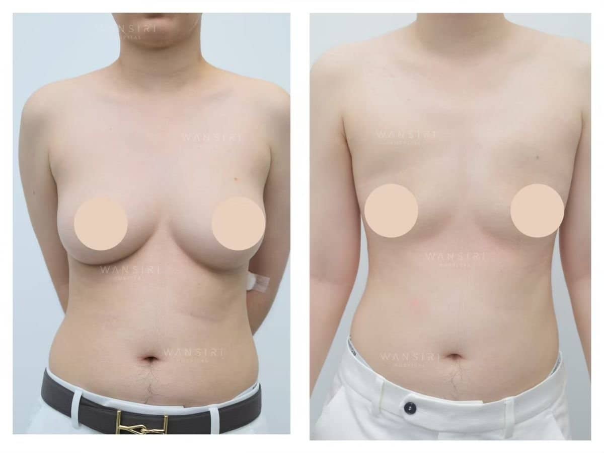 Case 17262 - top surgery