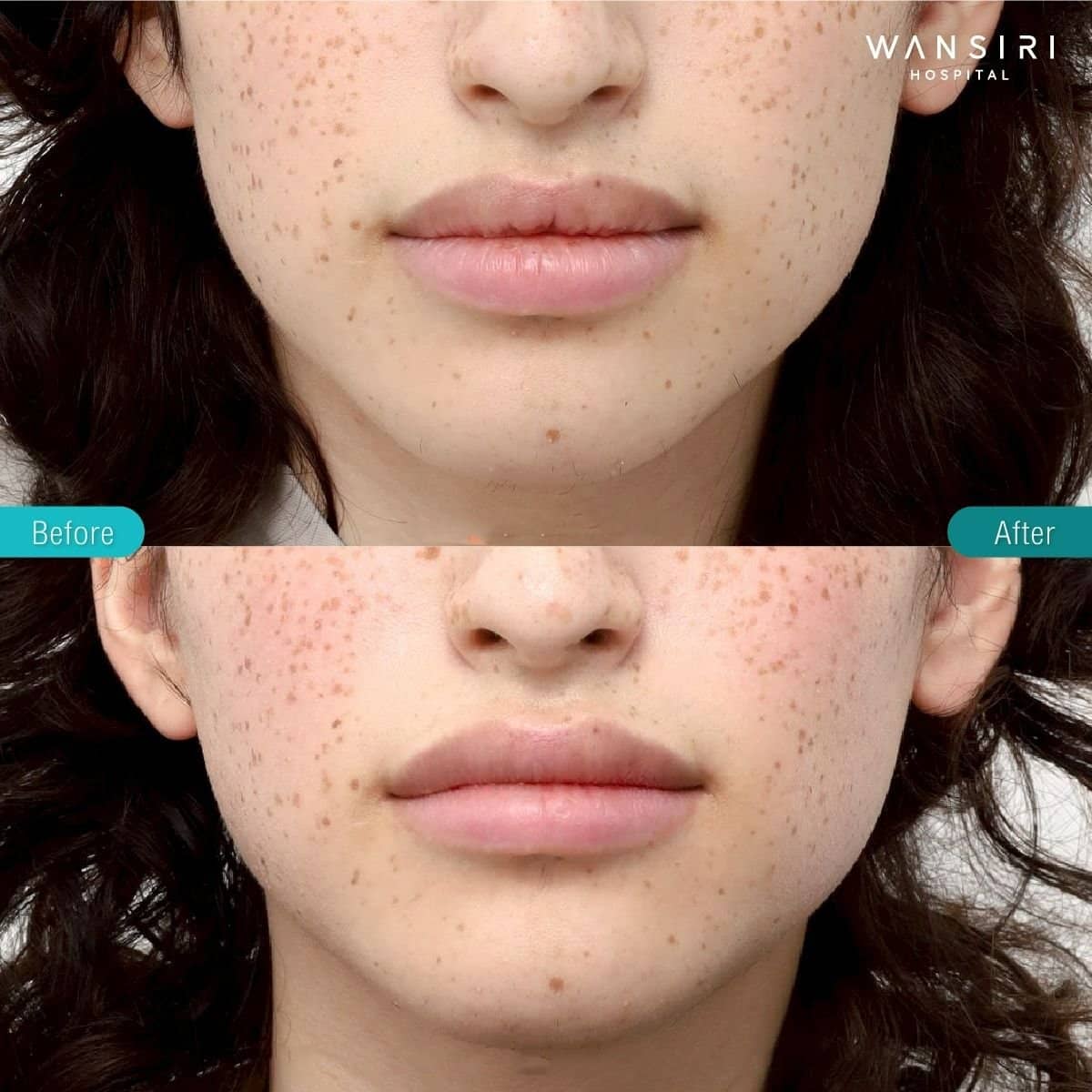 Case 17264 - lip lift