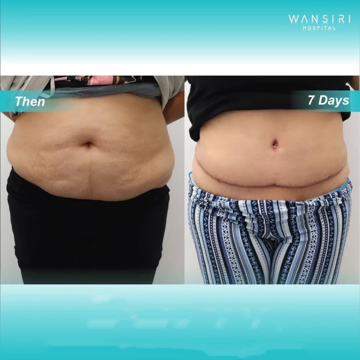 Case 17268 - tummy tuck and liposuction