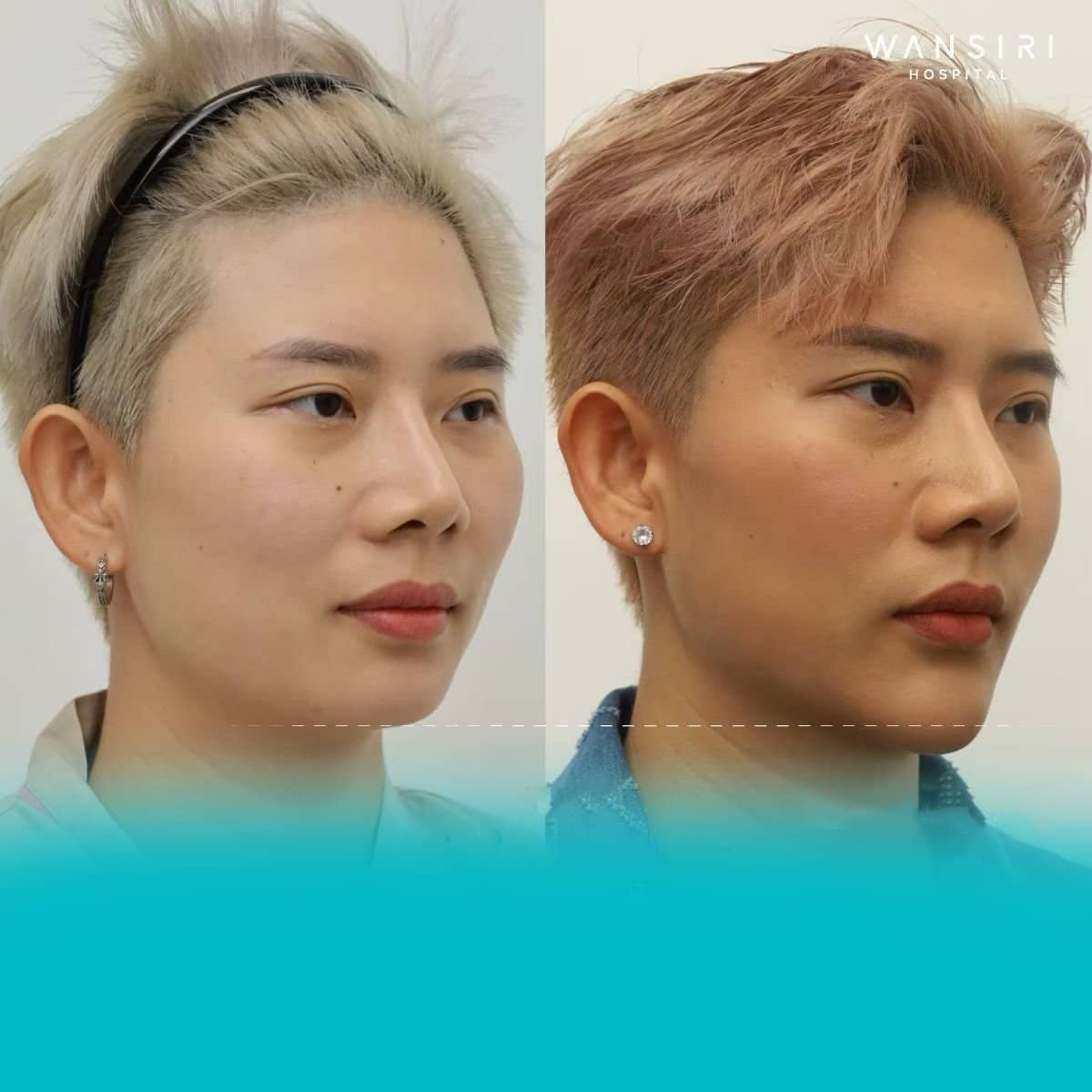 Case 17270 - chin implant
