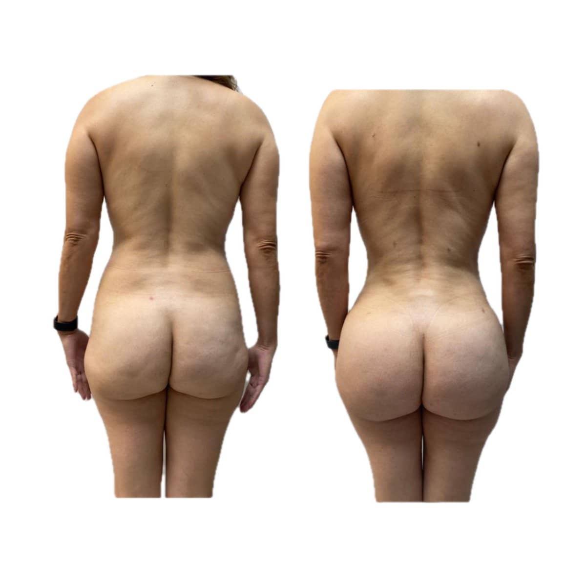 Case 17280 - Brazilian Butt Lift