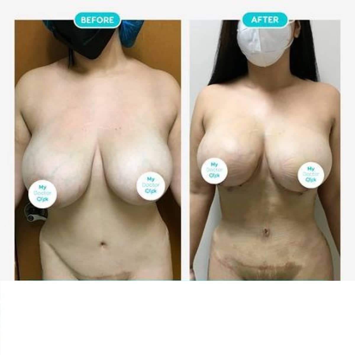 Case 17282 - breast lift