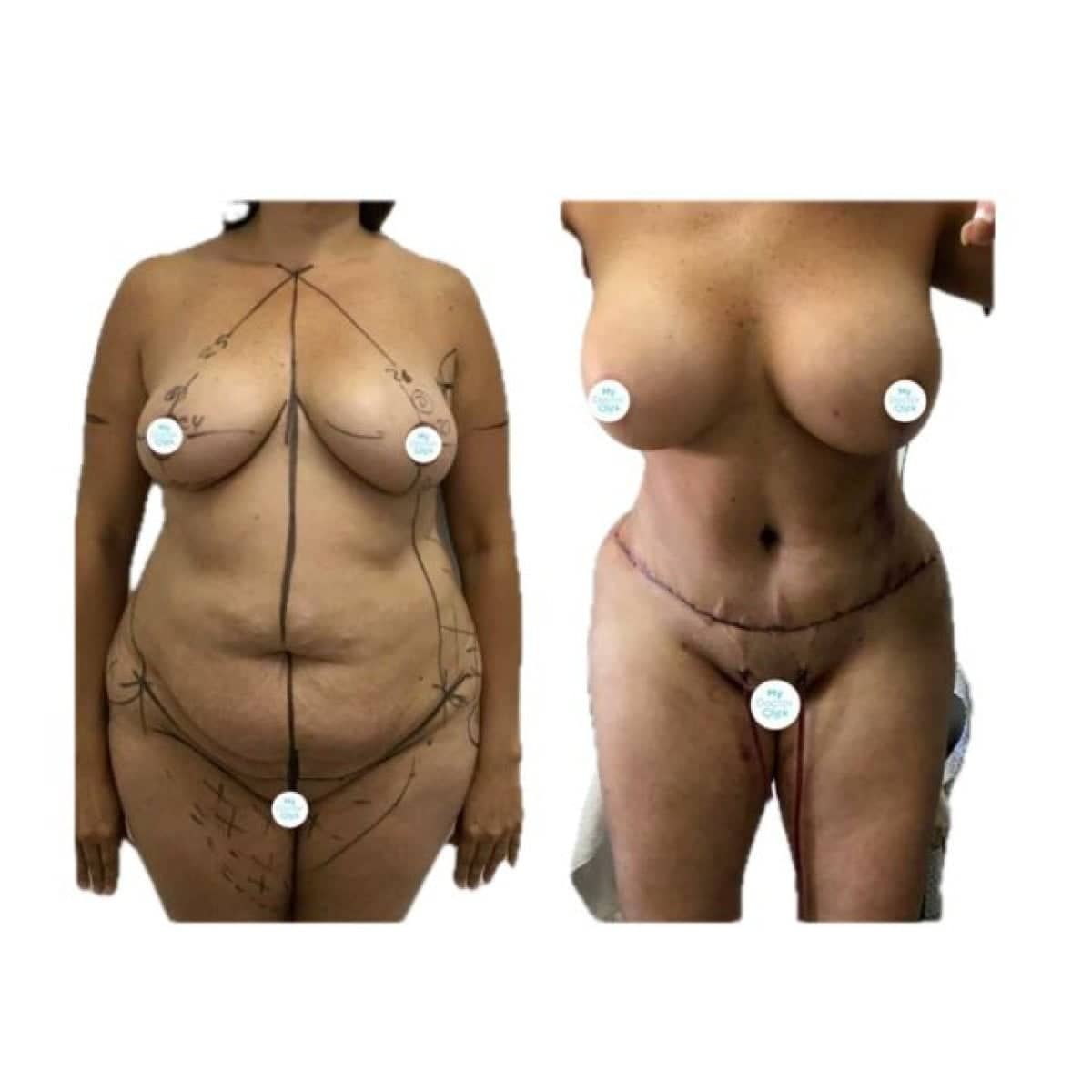 Case 17283 - breast lift and body contouring