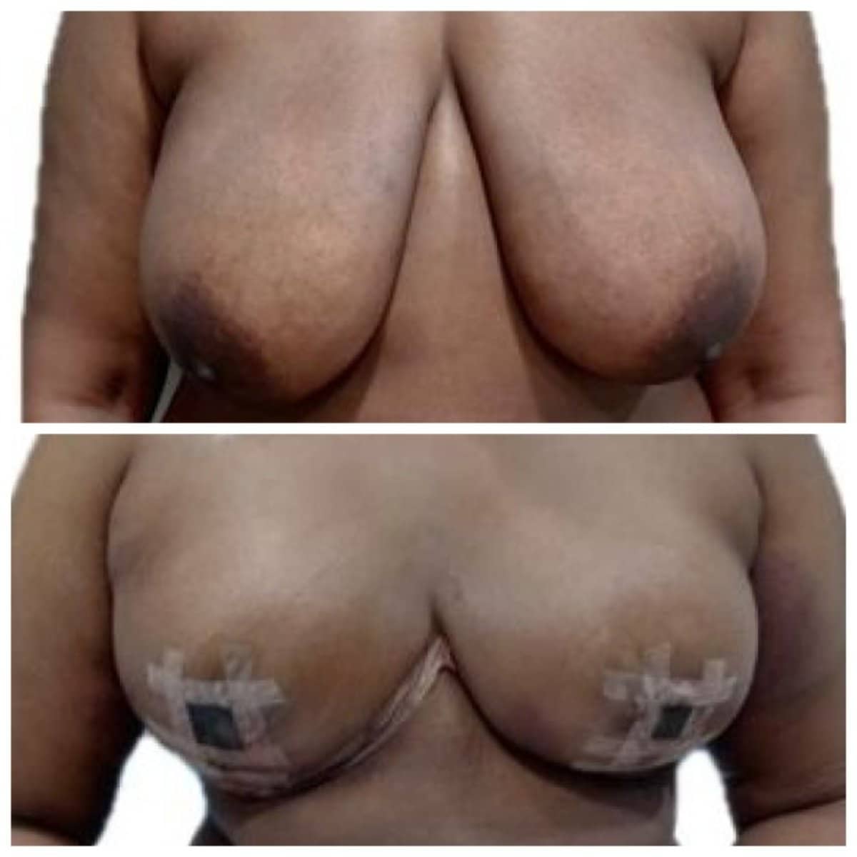 Case 17285 - breast reduction