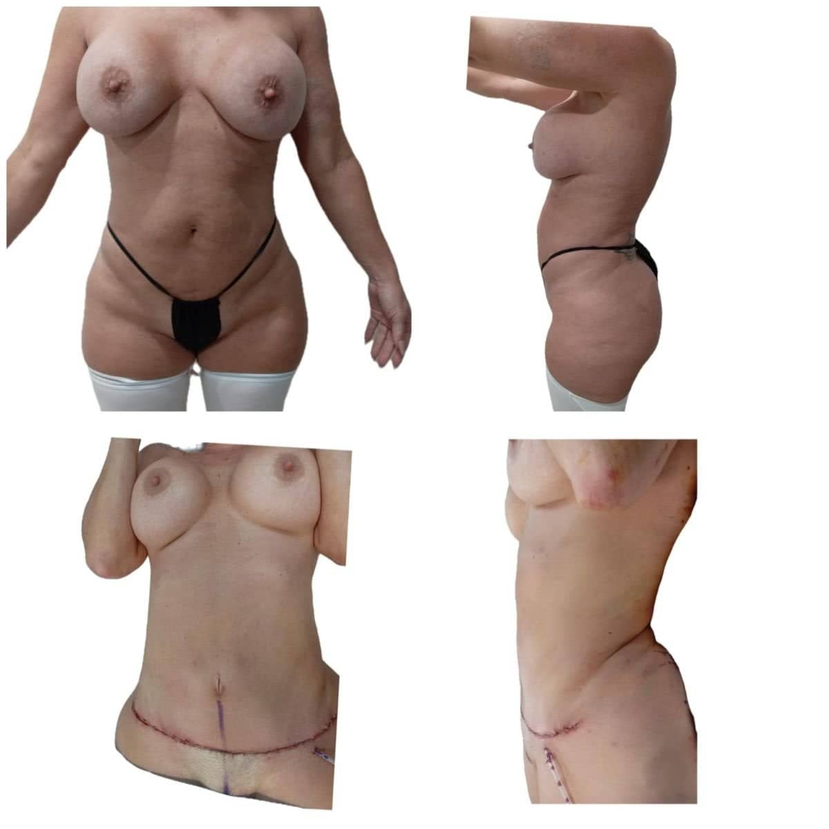 Case 17290 - tummy tuck