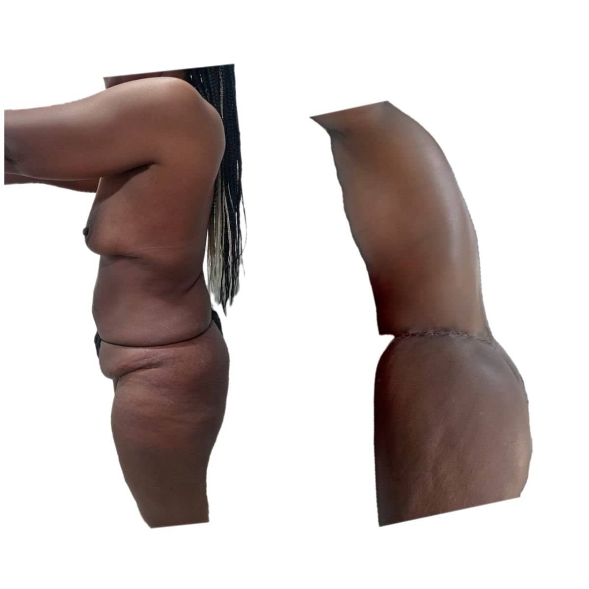 Case 17291 - post-bariatric plastic surgery